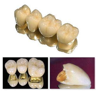 Притезирование зубов металлокерамикой, самая популярная услуга из видов протезирования.